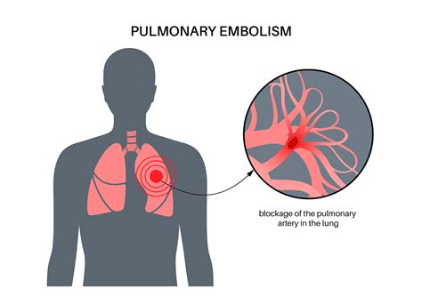 7 Signs You May Have a Deadly Pulmonary Embolism